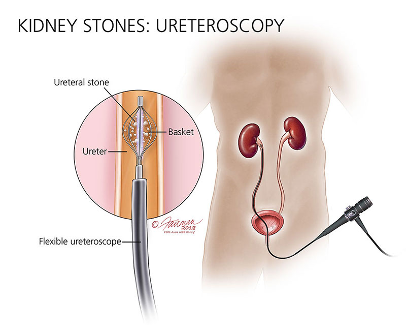 Pros and Cons of Ureteroscopy: Is It the Right Kidney Stone Removal Method for You?